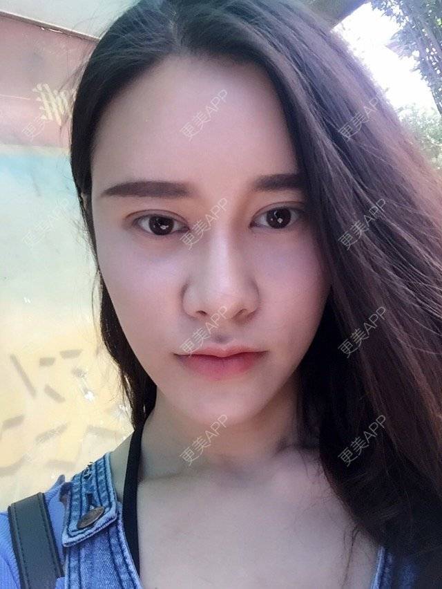 更美 - 福岁的祛眼袋经验 | 美购日记 | 祛眼袋 | 内路去眼袋 | 北京
