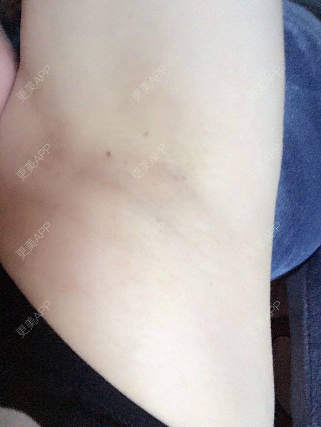 更美 - 洪荒之力要爆发啦的面部脱毛经验 | 杭州 | 面部脱毛 | 杭州瑞丽医疗美容医院 | 超冰脱毛