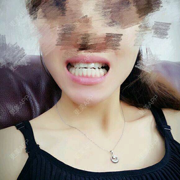 更美 - 乐莎莎口腔的隐形牙齿矫正经验 | 晒对比照 | 牙齿矫正 | 隐形牙齿矫正