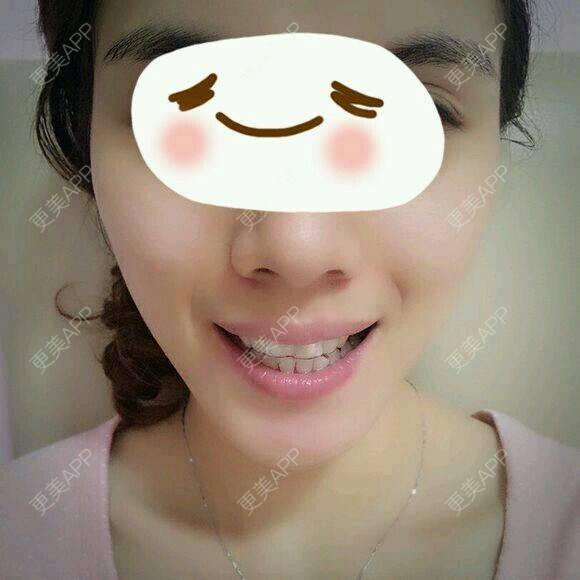 更美 - 乐莎莎口腔的隐形牙齿矫正经验 | 晒对比照 | 牙齿矫正 | 隐形牙齿矫正