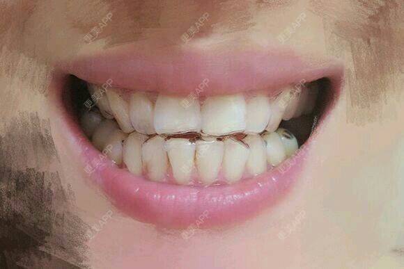 更美 - 乐莎莎口腔的隐形牙齿矫正经验 | 晒对比照 | 牙齿矫正 | 隐形牙齿矫正