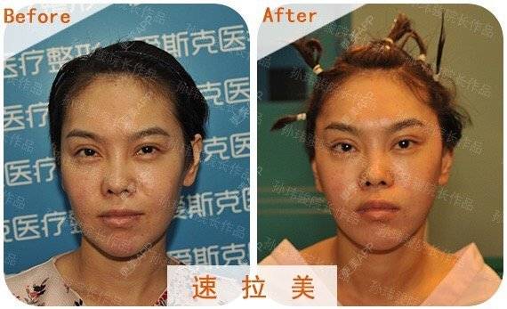 更美 - 苹果和小矮人的经验 | 黄金微针 | 北京