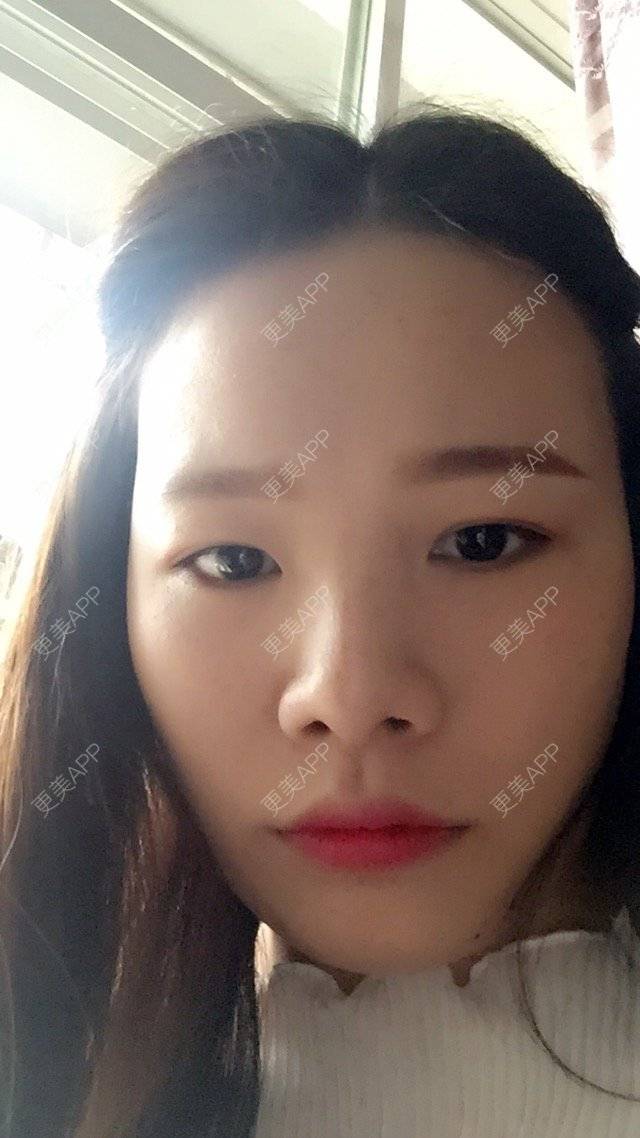 更美 - 小笨丹的经验 | 上眼睑去脂 | 赣州