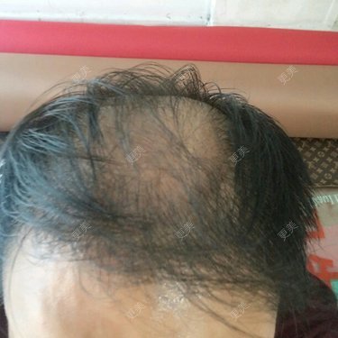 植发际线