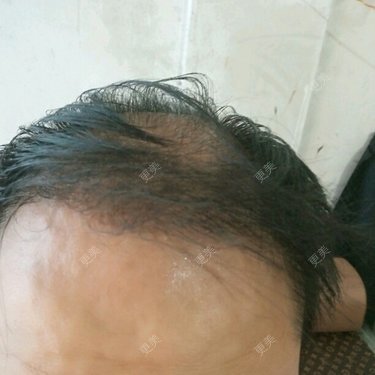 植发际线