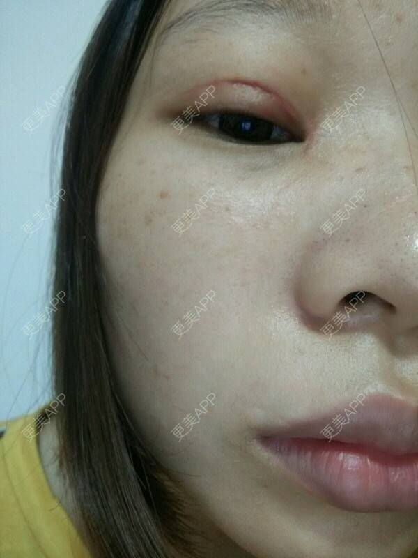 更美 - 不该。。。。。的经验 | 眼皮下垂矫正 | 宁德
