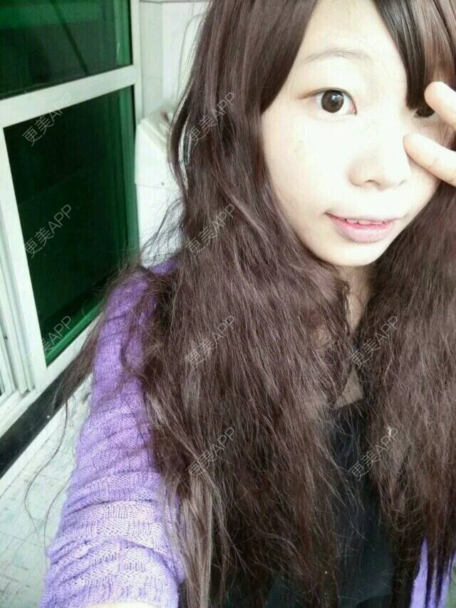 更美 - 不该。。。。。的经验 | 眼皮下垂矫正 | 宁德