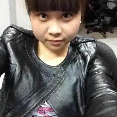注射溶脂瘦脸