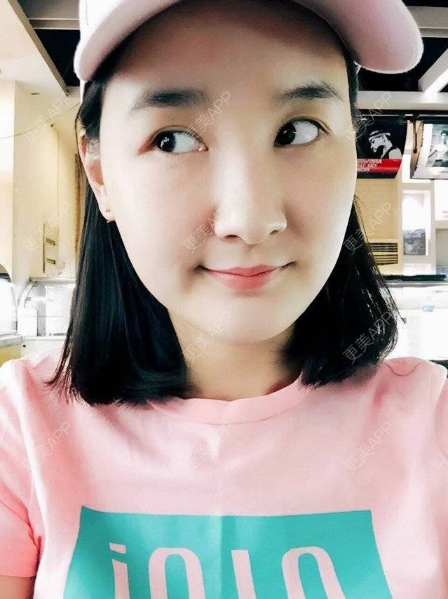 雨梦迟歌的自体脂肪填充面部