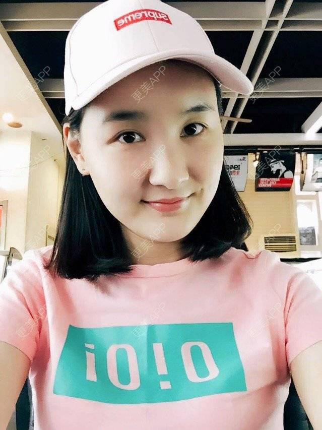 雨梦迟歌的自体脂肪填充面部