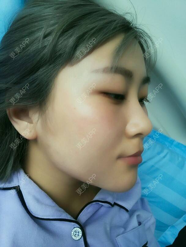 更美 - 不糖的经验 | 美购日记 | 双下巴 | 吸脂瘦脸 | 北京