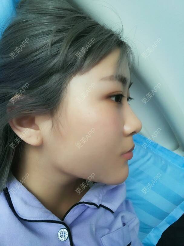 更美 - 不糖的经验 | 美购日记 | 双下巴 | 吸脂瘦脸 | 北京