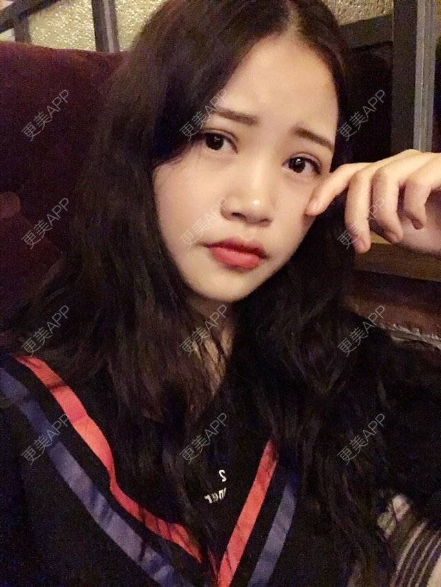 更美 - 哈的的经验 | 上眼睑去脂 | 德阳