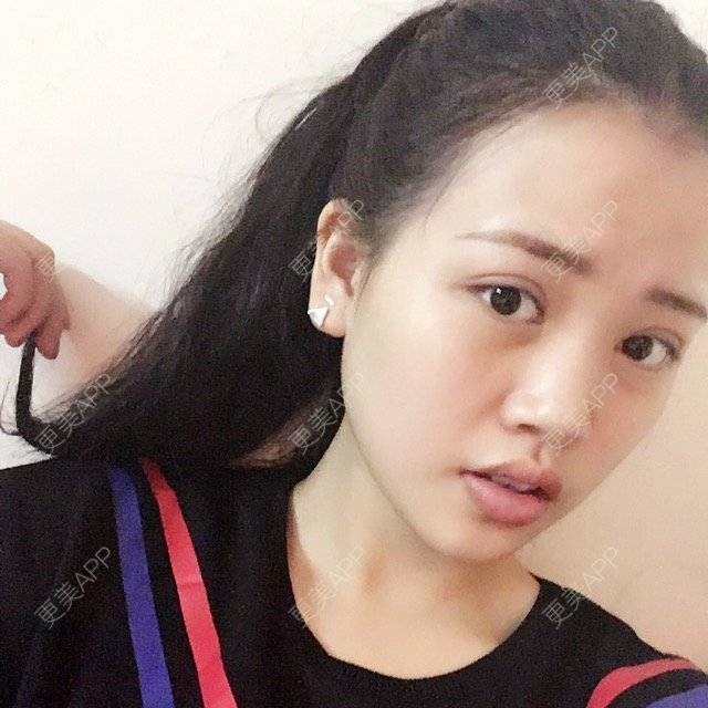 更美 - 哈的的经验 | 上眼睑去脂 | 德阳