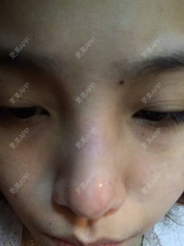 更美 - 更美用户gV5XG0tl2f的经验 | 玻尿酸溶解酶 | 深圳