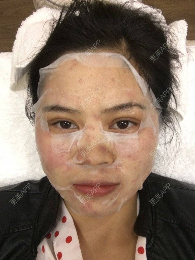 更美 - 布暧的激光淡斑经验 | 激光淡斑 | 成都 | IPL | 去雀斑