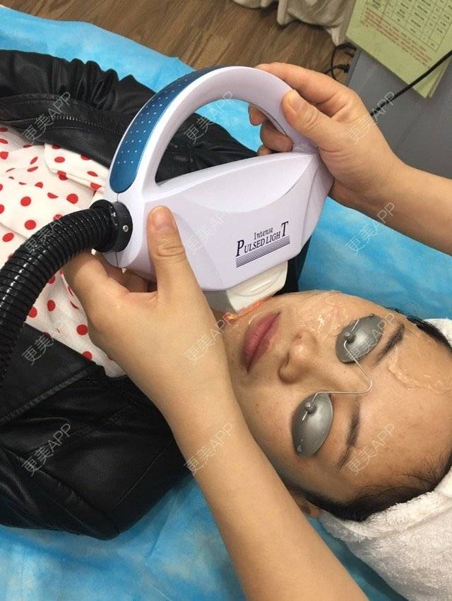 更美 - 布暧的激光淡斑经验 | 激光淡斑 | 成都 | IPL | 去雀斑