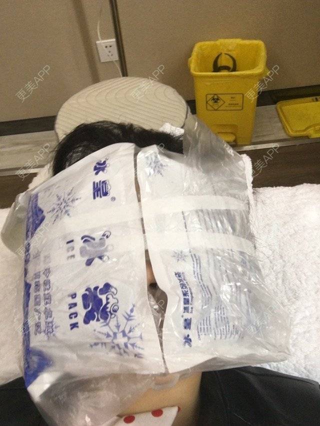 更美 - 布暧的激光淡斑经验 | 激光淡斑 | 成都 | IPL | 去雀斑
