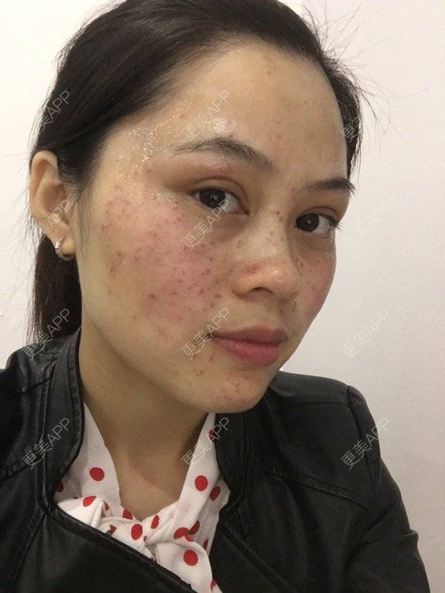 更美 - 布暧的激光淡斑经验 | 激光淡斑 | 成都 | IPL | 去雀斑