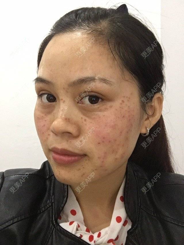 更美 - 布暧的激光淡斑经验 | 激光淡斑 | 成都 | IPL | 去雀斑