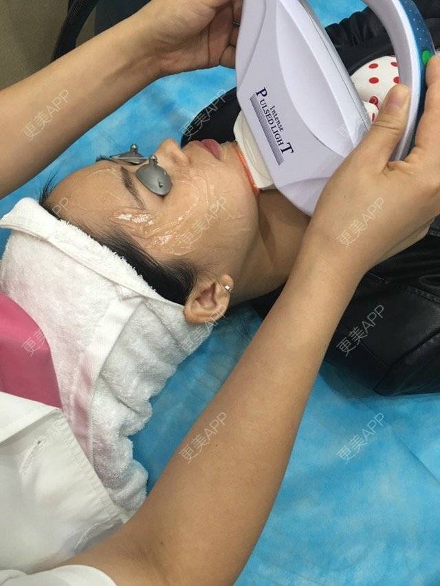 更美 - 布暧的激光淡斑经验 | 激光淡斑 | 成都 | IPL | 去雀斑