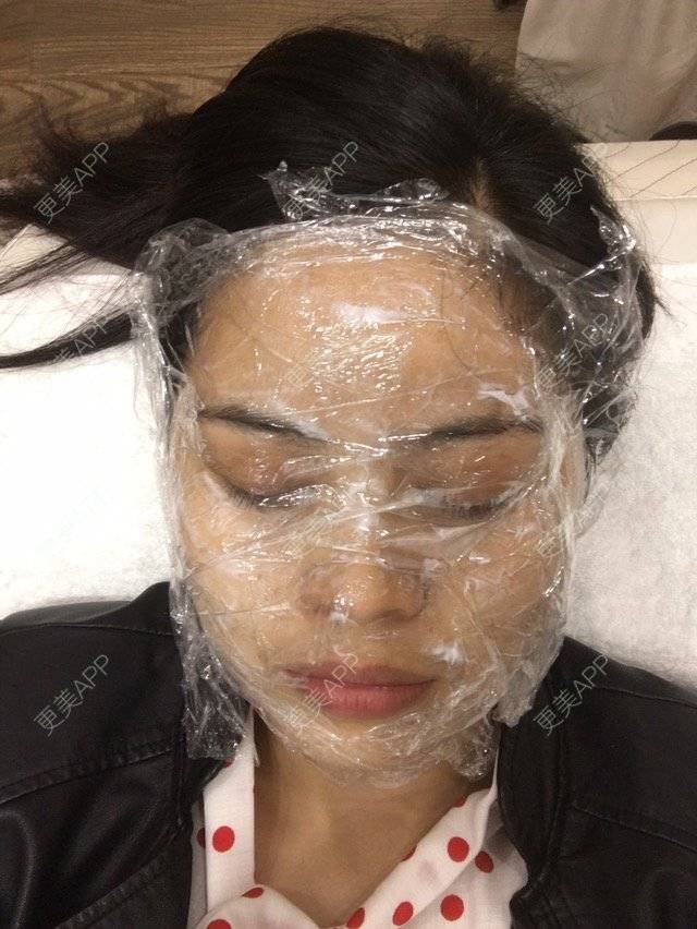 更美 - 布暧的激光淡斑经验 | 激光淡斑 | 成都 | IPL | 去雀斑