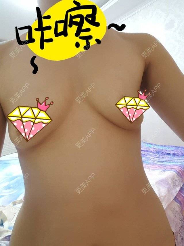 更美 - 拿铁未央的经验 | 假体隆胸 成都罗通贵 | 为男友隆胸 | 成都
