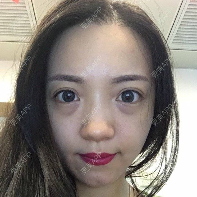 更美 - 更美用户Etr80x5EJZ的经验 | 眶隔脂肪释放 | 广州