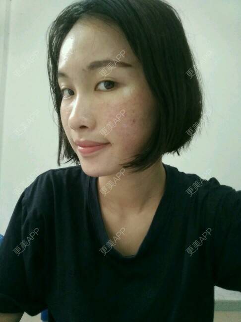 更美 - 苏瑾艺的光子嫩肤经验 | 美购日记 | 光子嫩肤 | 黑脸娃娃术后 | 微针祛痘印痘坑 | 南宁