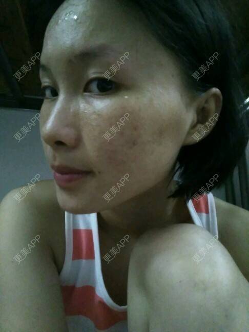 更美 - 苏瑾艺的光子嫩肤经验 | 美购日记 | 光子嫩肤 | 黑脸娃娃术后 | 微针祛痘印痘坑 | 南宁