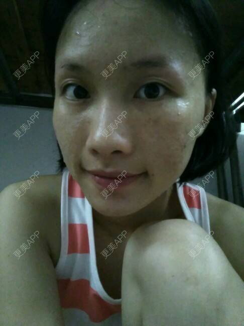 更美 - 苏瑾艺的光子嫩肤经验 | 美购日记 | 光子嫩肤 | 黑脸娃娃术后 | 微针祛痘印痘坑 | 南宁