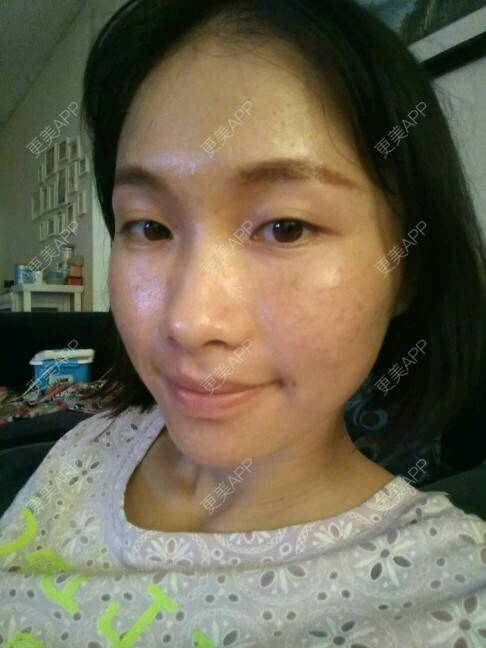 更美 - 苏瑾艺的光子嫩肤经验 | 美购日记 | 光子嫩肤 | 黑脸娃娃术后 | 微针祛痘印痘坑 | 南宁