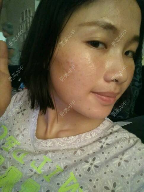 更美 - 苏瑾艺的光子嫩肤经验 | 美购日记 | 光子嫩肤 | 黑脸娃娃术后 | 微针祛痘印痘坑 | 南宁