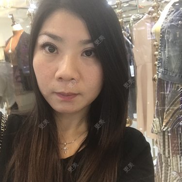 注射溶脂瘦脸