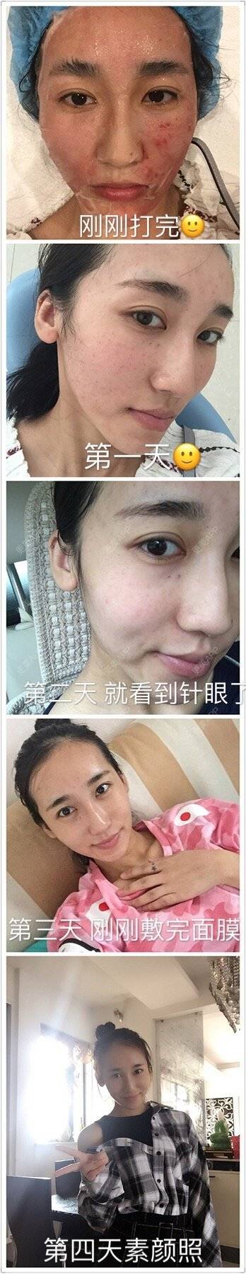 更美 - 小Ma童鞋的水光项目经验 | 玻尿酸填充鼻山根 | 水光项目 | 武汉