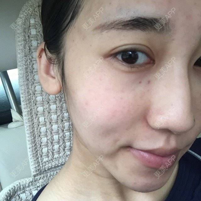 更美 - 小Ma童鞋的水光项目经验 | 玻尿酸填充鼻山根 | 水光项目 | 武汉