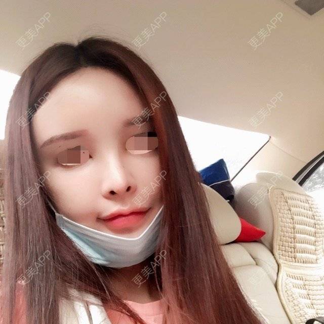 更美 - 卡卡妞儿的自体脂肪全面部填充经验 | 北京 | 自体脂肪全面部填充