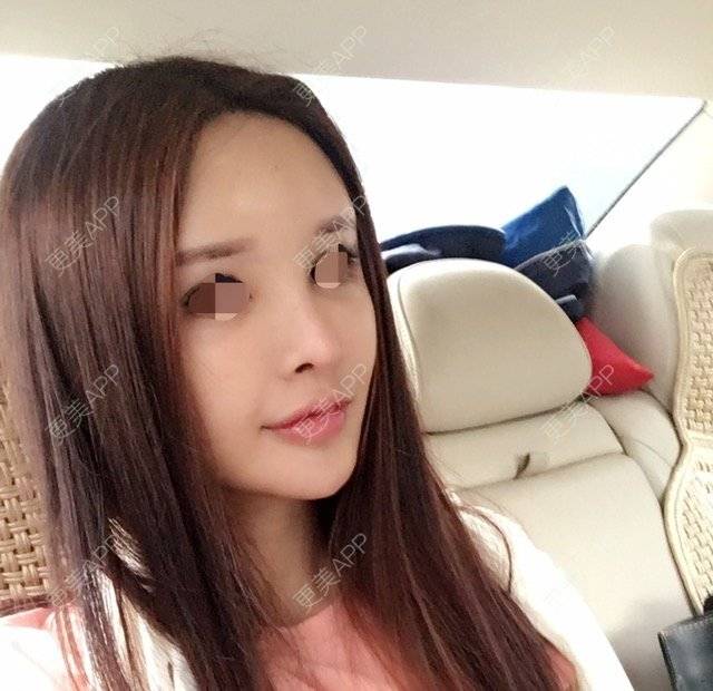 更美 - 卡卡妞儿的自体脂肪全面部填充经验 | 北京 | 自体脂肪全面部填充