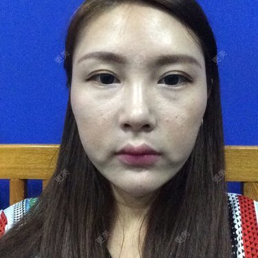 嘴角两边的两坨肉快把我愁死了求求大家了改怎么做才能好看