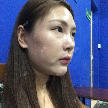 嘴角两边的两坨肉快把我愁死了求求大家了改怎么做才能好看