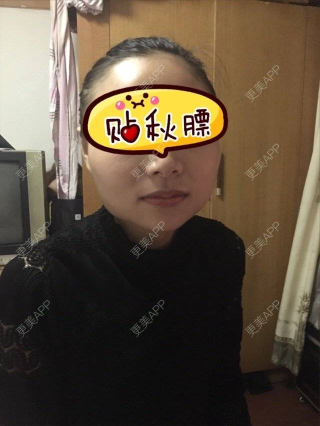 更美 - 家住山脚的姜小姐的除皱瘦脸经验 | 美购日记 | 除皱瘦脸 | 金华