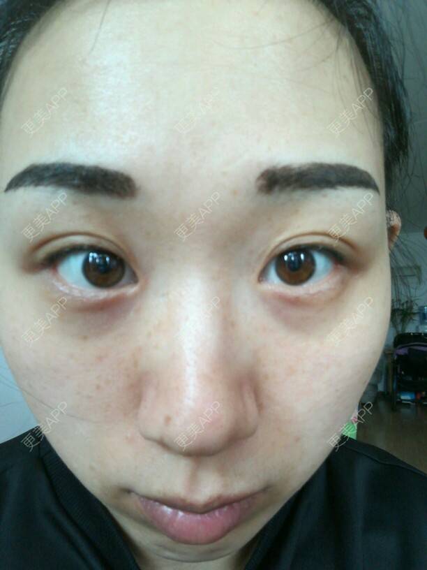 更美 - 更美用户7W4Q5YZvDi的经验 | 祛除黑眼圈 | 北京