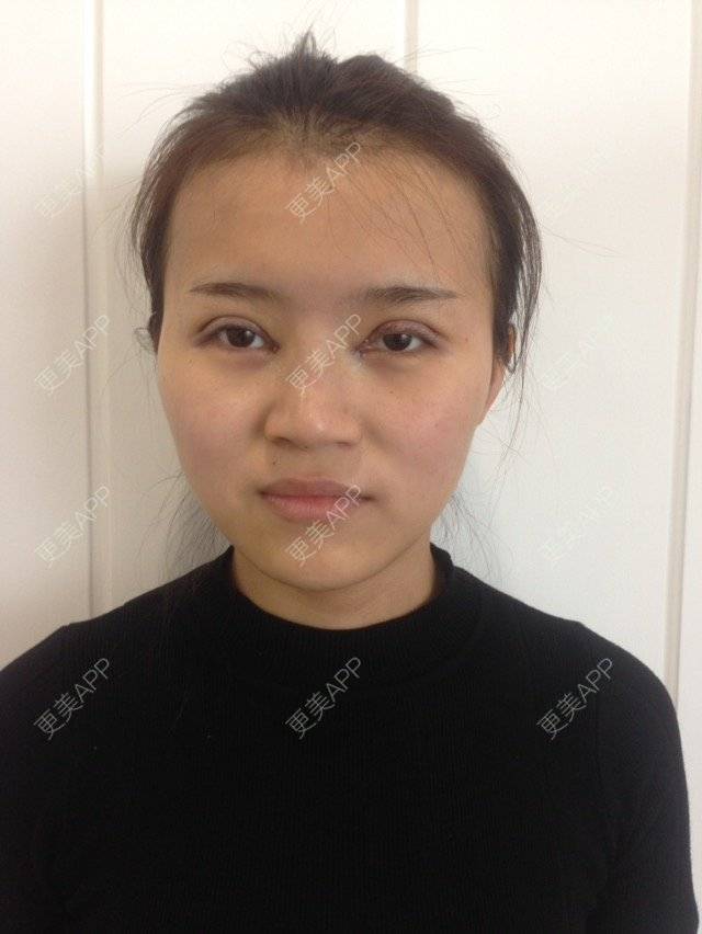 更美 - 更美用户MPsxvuz13R的全切双眼皮经验 | 开内眼角 | 进口玻尿酸填充鼻子 | 全切双眼皮 | 全切双眼皮去皮去脂肪 | 成都
