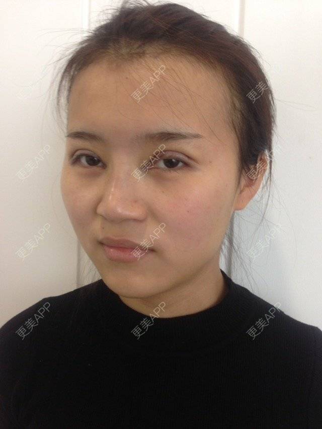 更美 - 更美用户MPsxvuz13R的全切双眼皮经验 | 开内眼角 | 进口玻尿酸填充鼻子 | 全切双眼皮 | 全切双眼皮去皮去脂肪 | 成都