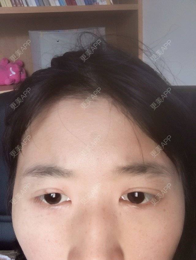 更美 - 更美用户O2quKPWFdQ的经验 | 在线面诊四 | 双眼皮 | 修复双眼皮