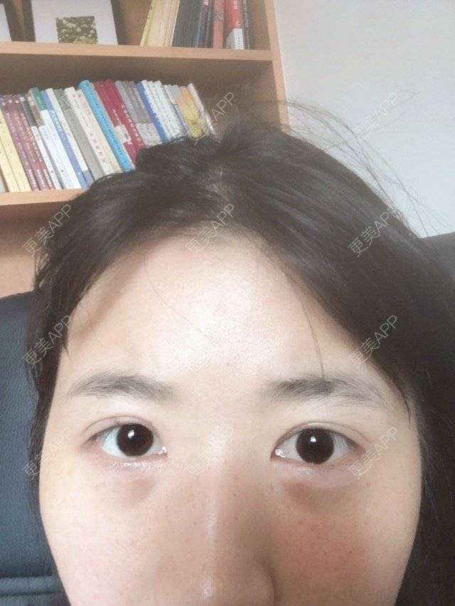 更美 - 更美用户O2quKPWFdQ的经验 | 在线面诊四 | 双眼皮 | 修复双眼皮