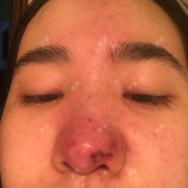 栓塞了今天已经溶了也打了点滴但是太阳穴一直有点疼跟栓塞会有关系麽