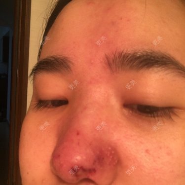 栓塞了今天已经溶了也打了点滴但是太阳穴一直有点疼跟栓塞会有关系麽