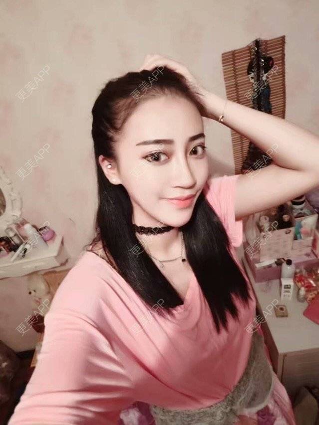 更美 - 兔宝宝的宝贝的自体脂肪全面部填充经验 | 自体脂肪全面部填充 | 面部轮廓 | 福州 | 热门讨论 | 面部吸脂填充 | 美购日记