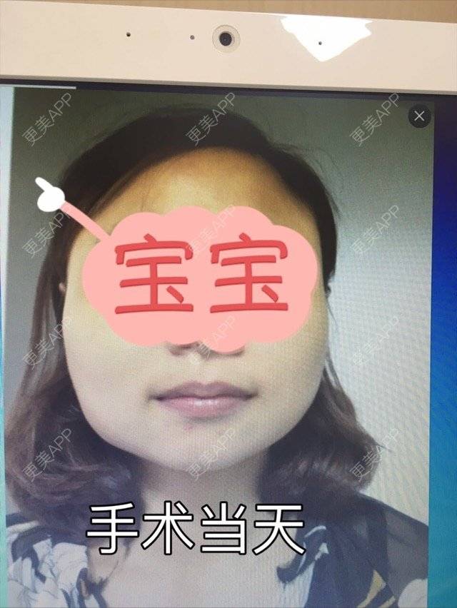 更美 - 家住山脚的姜小姐的除皱瘦脸经验 | 美购日记 | 除皱瘦脸 | 金华